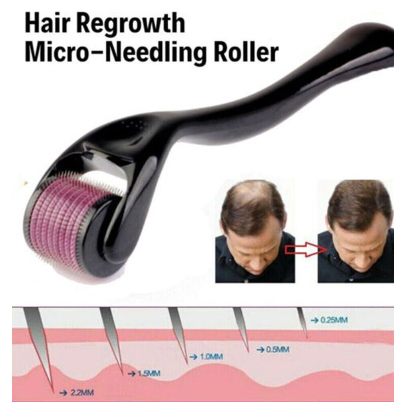 Derma Roller| Micro Needling Treatment