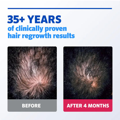 Minoxidil Hair growth Solution™